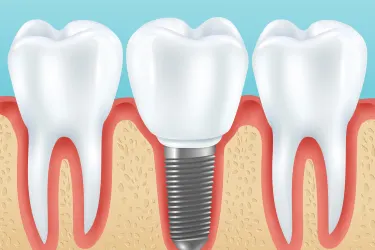 Dental Implant at Samadhan Clinic, Dwarka