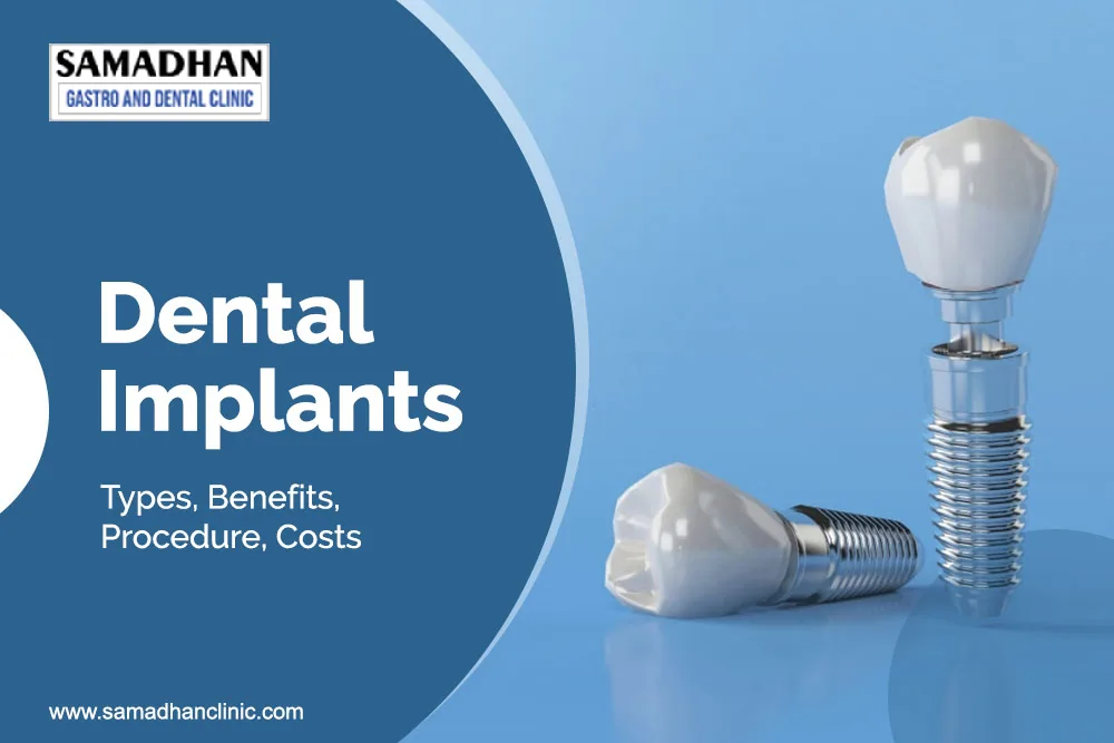 dental implants guide
