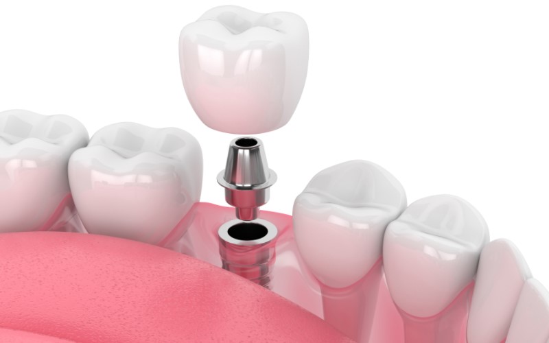 types of dental implants cost in india