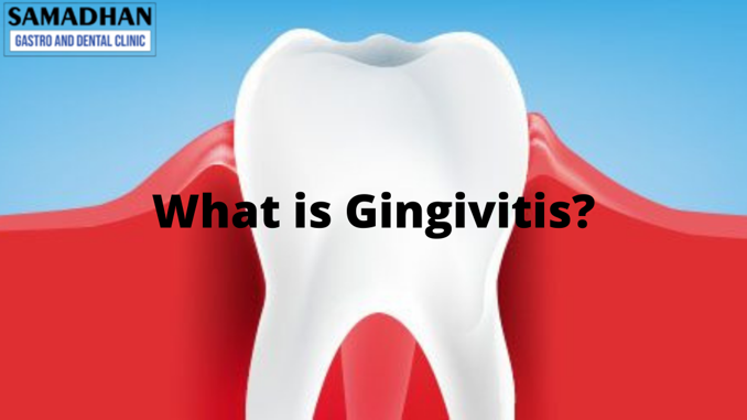 gingivitis-symptoms-causes-treatment