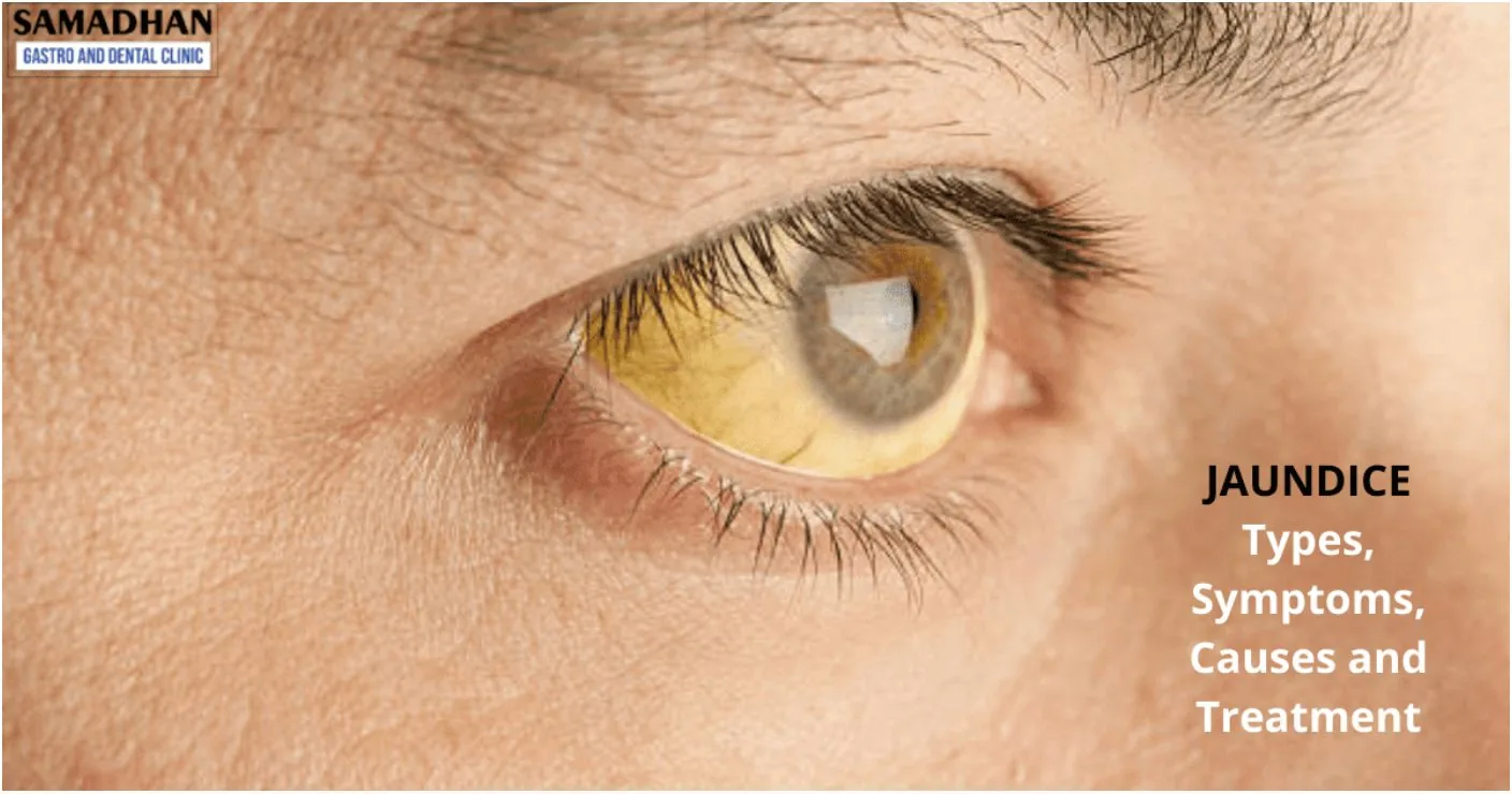 Jaundice Treatment