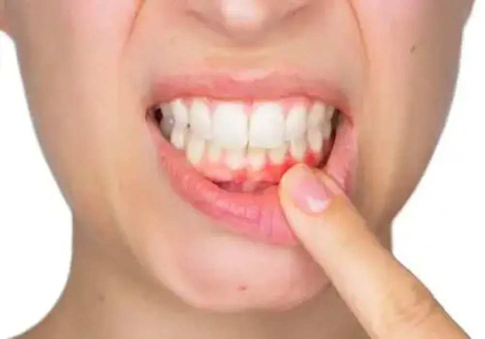 Pyorrhea