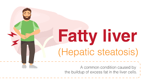 tips-to-reduce-fatty-liver-by-liver-specialist-in-delhi